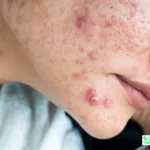 jerawat batu di wajah