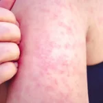 wabah campak Florida terbaru