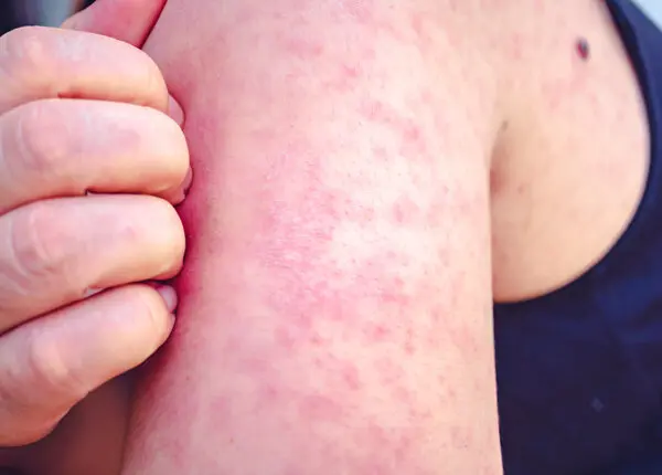 wabah campak Florida terbaru