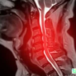 AI Spinal Cord Disease Prediction