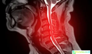 AI Spinal Cord Disease Prediction