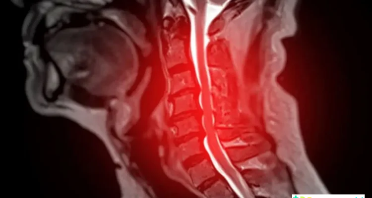 AI Spinal Cord Disease Prediction