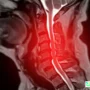 AI Spinal Cord Disease Prediction
