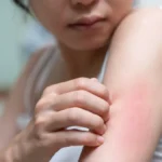 Penyakit Kulit, Gejala dan Jenis Jenisnya yang Perlu Diwaspadai