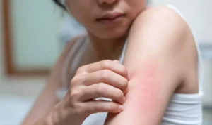 Penyakit Kulit, Gejala dan Jenis Jenisnya yang Perlu Diwaspadai