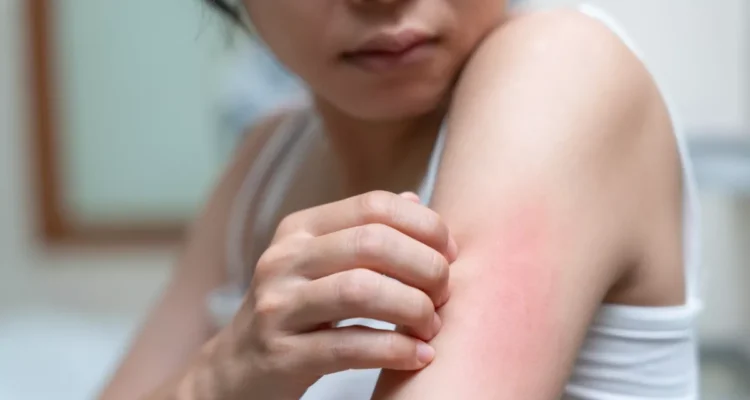 Penyakit Kulit, Gejala dan Jenis Jenisnya yang Perlu Diwaspadai