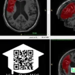 open data stroke recovery
