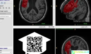 open data stroke recovery
