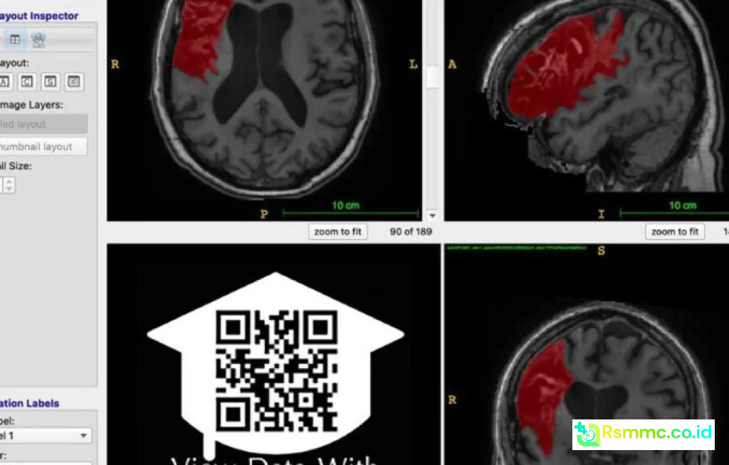 open data stroke recovery
