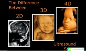 USG 2D dan 4D USG 2D dan 4D