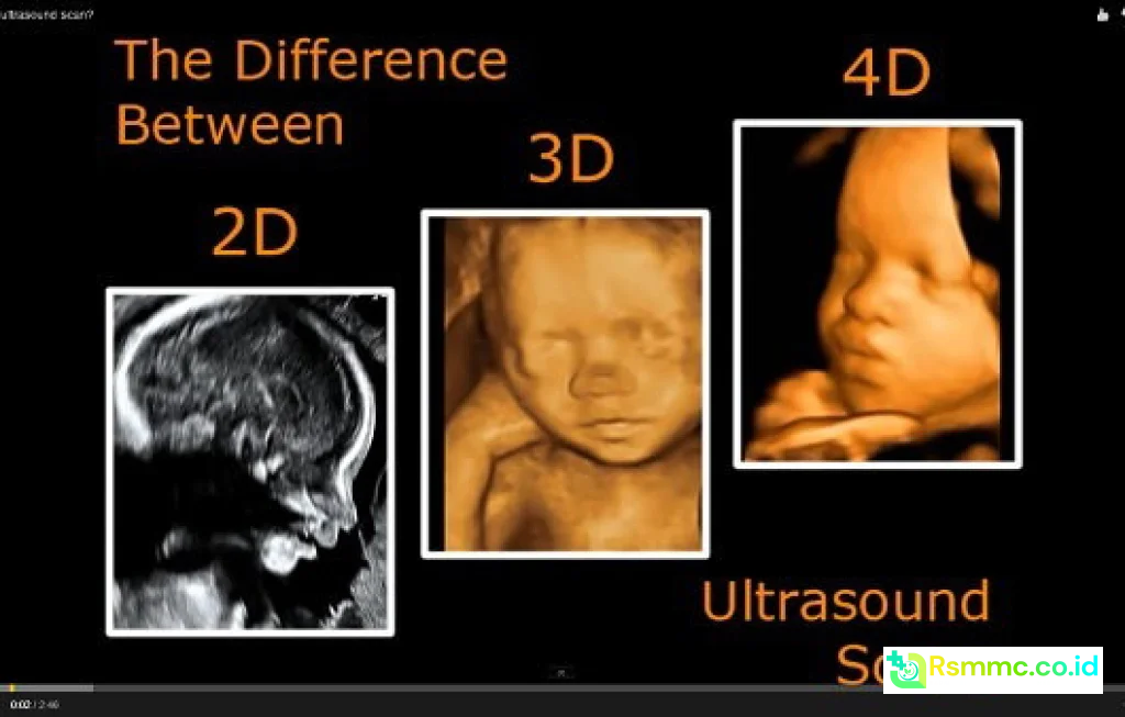 USG 2D dan 4D