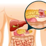 Kerentanan Tumor Pankreas Celah Baru Obati Kanker Mematikan