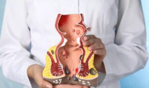 Penyebab Ambeyen yang Sering Diabaikan, Kenali Sebelum Makin Mengganggu