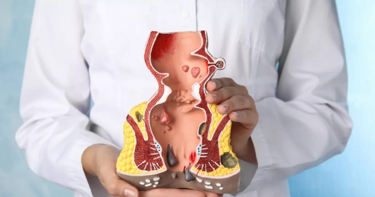 Penyebab Ambeyen yang Sering Diabaikan, Kenali Sebelum Makin Mengganggu