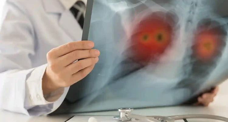 Urine nanosensor kanker paru deteksi dini, dokter kaget!