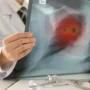 Urine nanosensor kanker paru deteksi dini, dokter kaget!