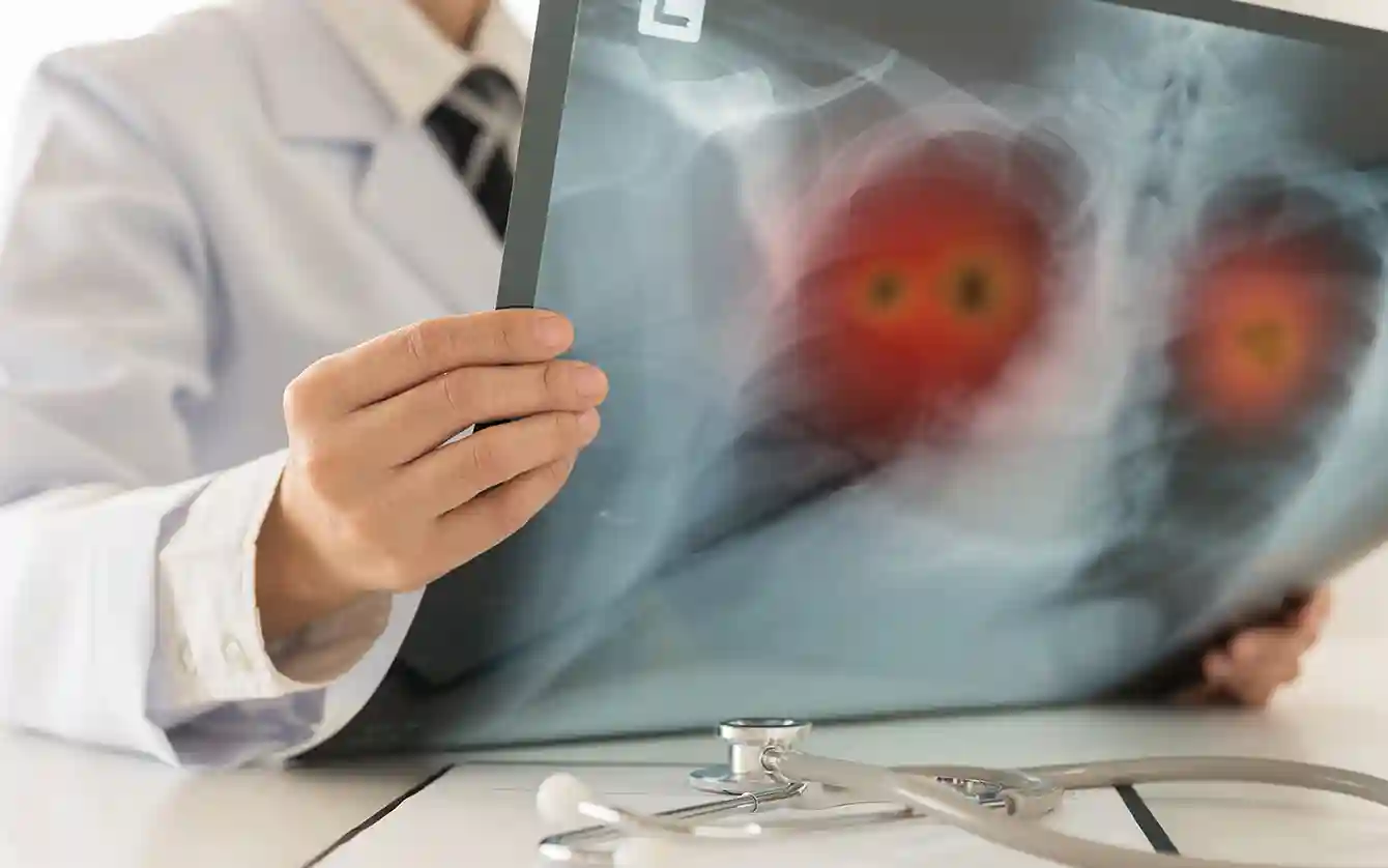Urine nanosensor kanker paru deteksi dini, dokter kaget!